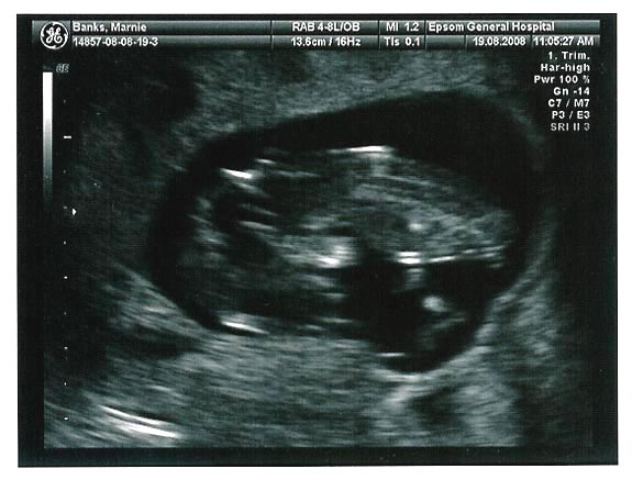 [The first look at our second baby]