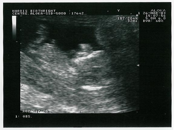 [The first look at our baby]