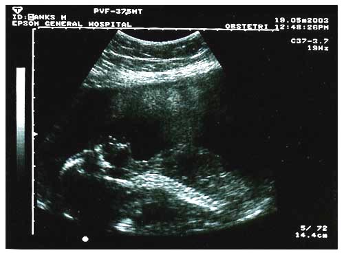 [Our baby at 20 weeks]
