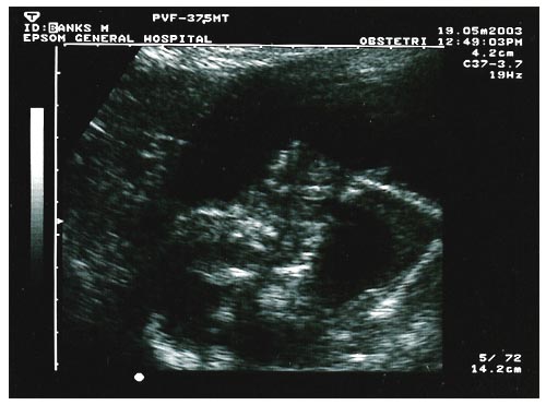 [Our baby at 20 weeks]
